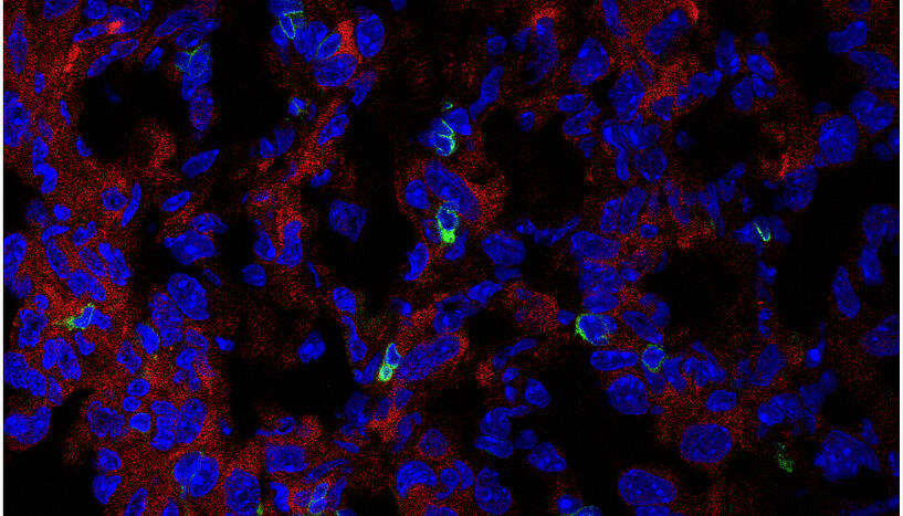 Fig. 1: Immunofluorescence image of the expression of PHGDH (red) and CD3 T cells (green) in cryosectioned AE17 mesothelioma.